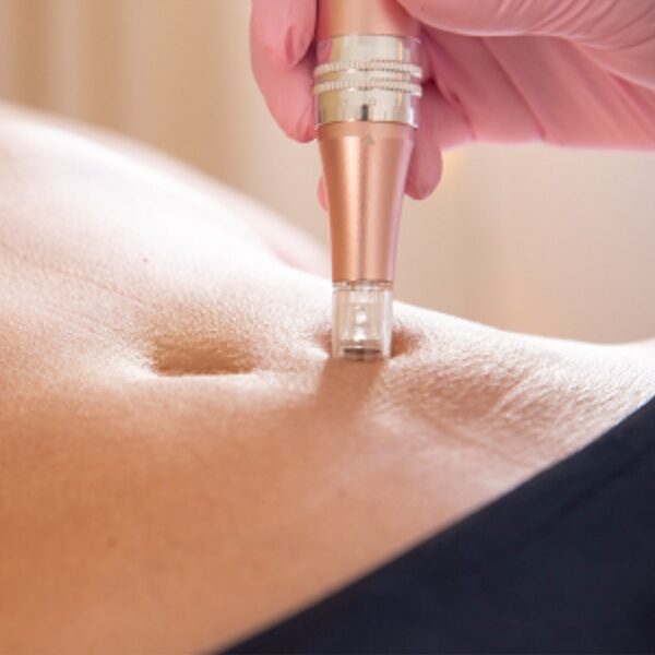 Lovital Fisioterapia - Dermapen Lovital Fisioterapia - Servicios, tratamiento Dermapen para la renovación celular